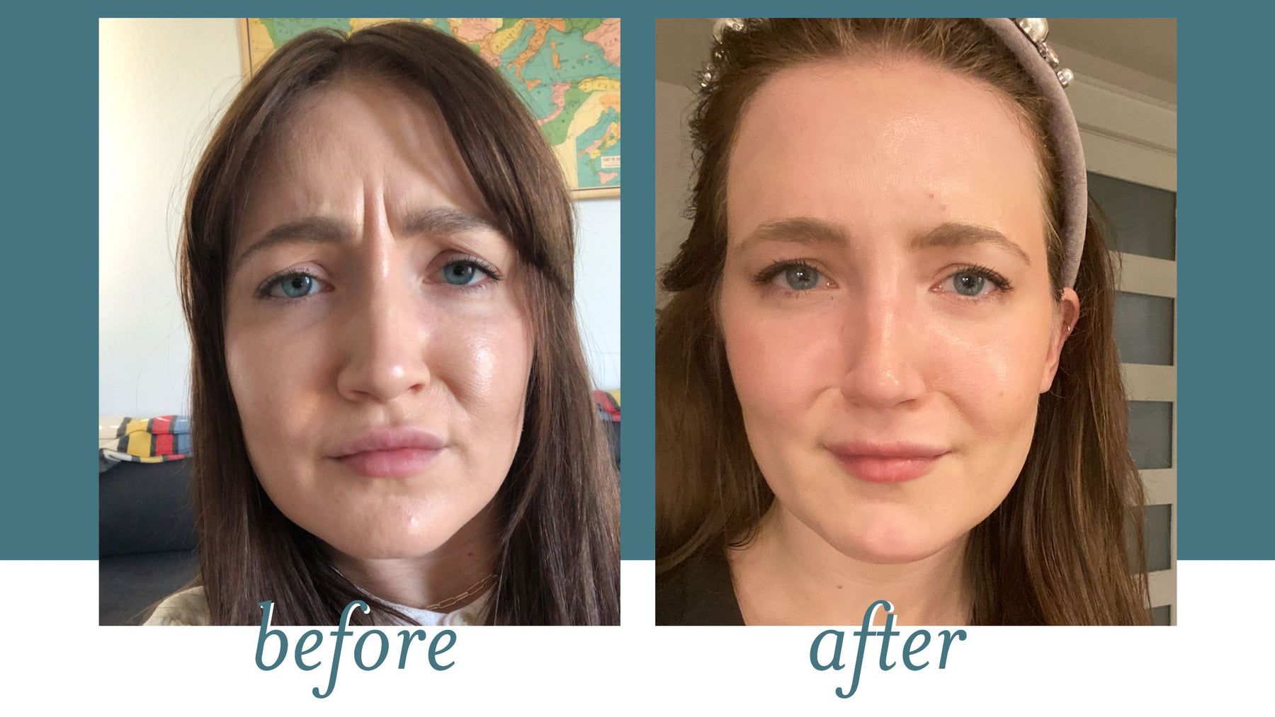 First-Time Xeomin Experience: What I Really Think