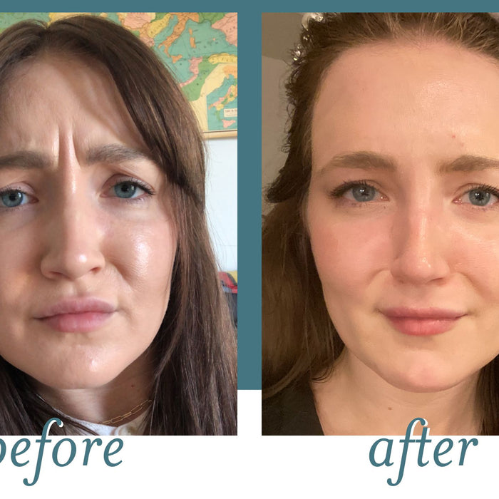 First-Time Xeomin Experience: What I Really Think