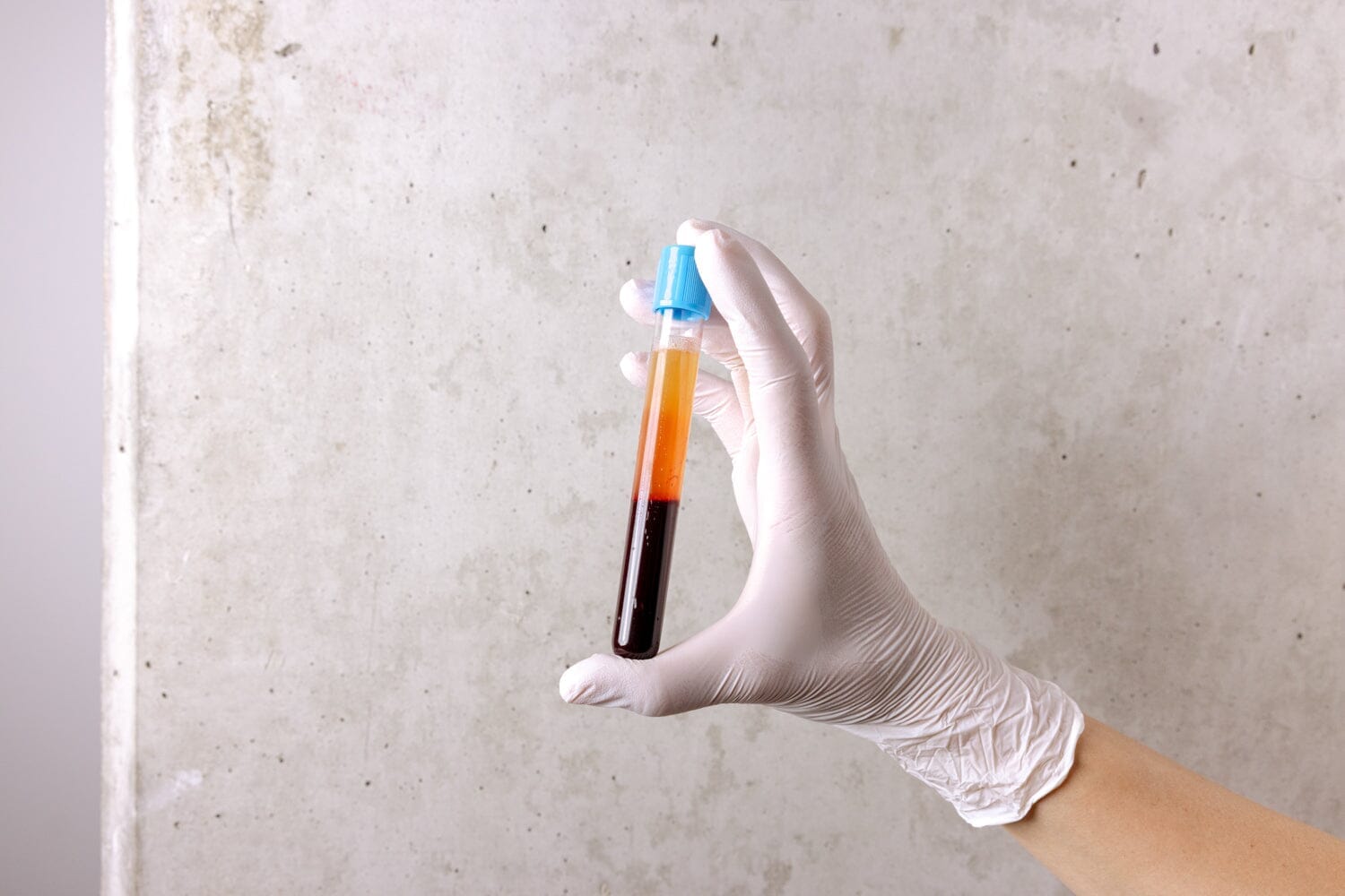 PRP for Hair Loss: What It Is, How It Works & What to Expect