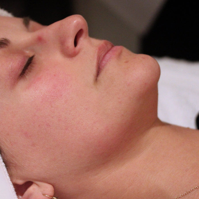 What Is the Perk Treatment?