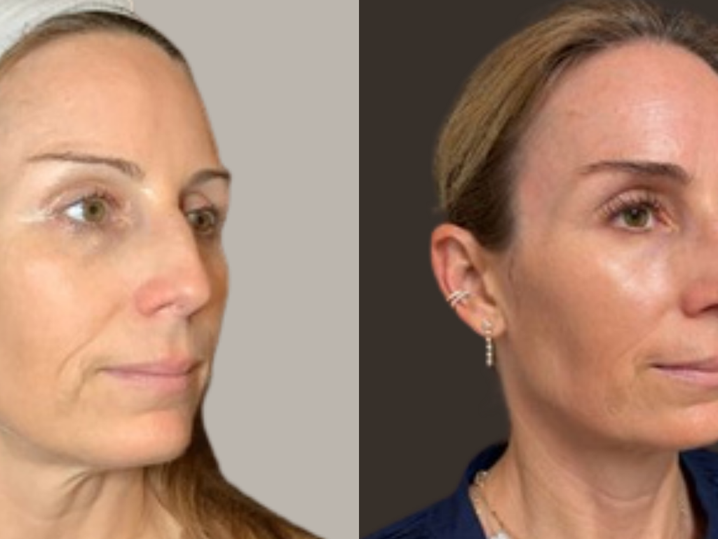 Before-and-after side-by-side portrait comparison of a woman's face, showing skin texture and appearance changes against a neutral gray and dark brown background.