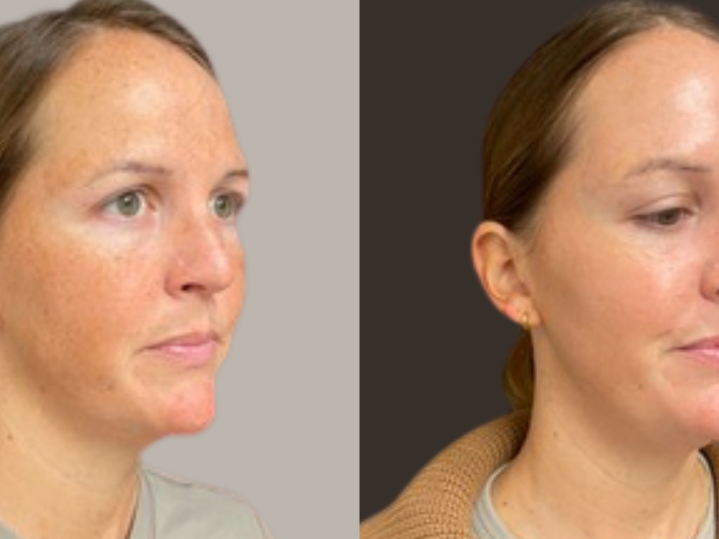 Before-and-after side-by-side comparison of a woman's face, showing a skincare or cosmetic treatment result. The left side has a light gray background, and the right side has a dark brown background.