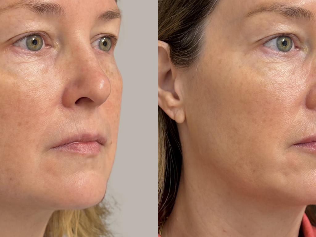 Before-and-after side-by-side close-up portraits of a woman's face, likely demonstrating skincare or cosmetic results.