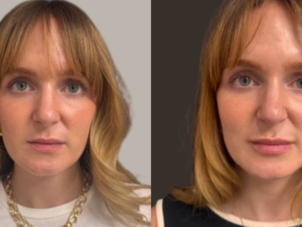 A side-by-side before and after style portrait of a woman with blonde hair, showing a cosmetic or skincare result against a neutral background.