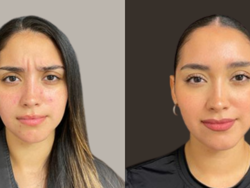 A side-by-side before and after comparison of a woman's face, showing skin improvement on the right side against a dark brown background and a light gray background on the left.