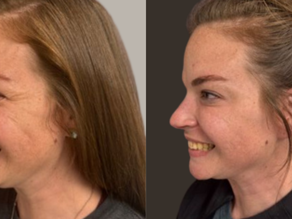Side-by-side before and after profile photos of a woman with light brown hair, smiling, set against a neutral gray background.
