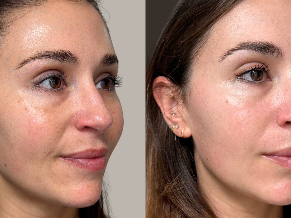 Before and after side-by-side comparison of a woman's face showing skin texture and pore improvement, with her hair pulled back and wearing small hoop earrings.