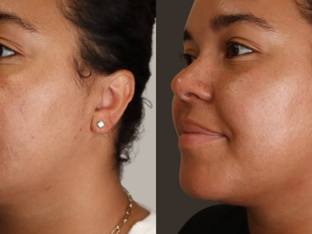 A side-by-side before and after comparison of a woman's ear, showing a small white stud earring on the left and a pair of gold hoop earrings on the right.