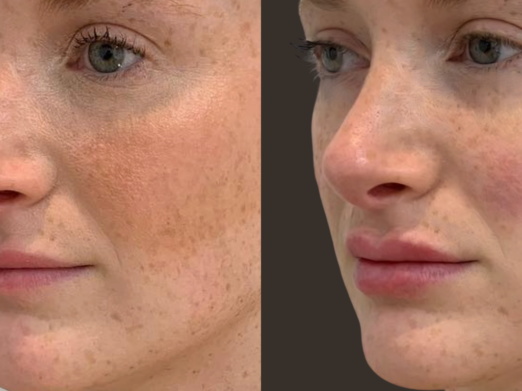 Before-and-after side-by-side comparison of a woman's face, showing a reduction in visible freckles and redness on her nose and cheek.