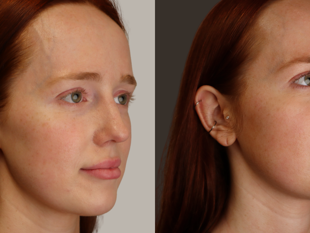 A side-by-side before and after comparison of a woman's face, showing a visible improvement in skin texture and appearance on her cheek and jawline against neutral studio backgrounds.