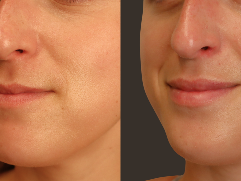 A close-up before-and-after style comparison of a woman's lower face, showing skin texture and appearance in two side-by-side panels.